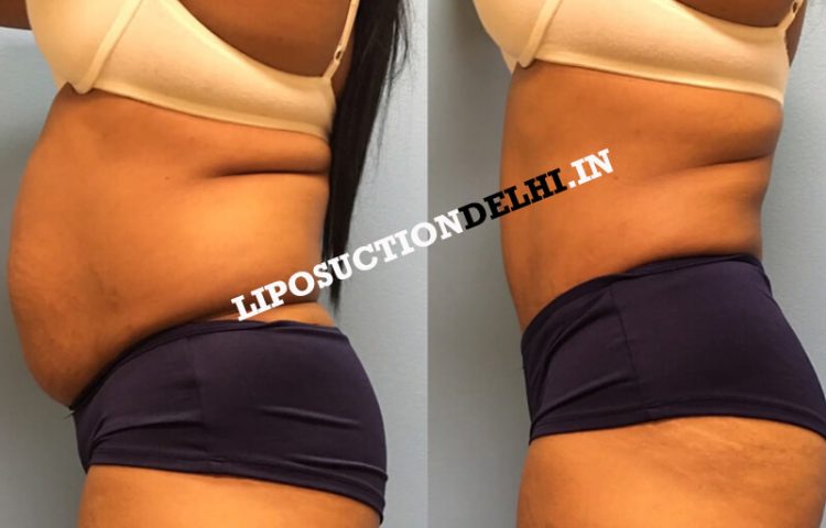 side abdomen liposuction